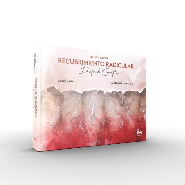 Recubrimiento Radicular – Desafiando Conceptos - Ed Espanhol